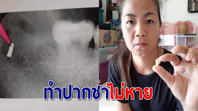 ร้อง หมอชุ่ย ผ่าฟันคุด ดันลืม “หัวกรอฟัน” ในเหงือกทรมานนาน 5 ปี