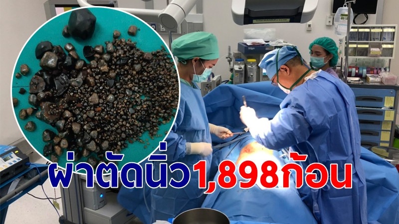 รพ.ดังหนองคาย ผ่าตัดนิ่ว ทุบสถิติ 1,898 ก้อน ชี้คนอีสานป่วยมากสุด