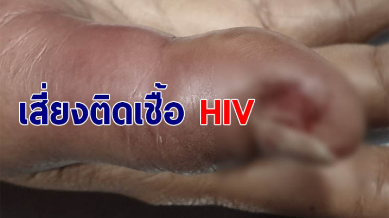 อุทาหรณ์! หญิงวัย 35 ติดเชื้อปลายกระดูกนิ้ว เสี่ยงพิการ - Hiv เพราะทำเล็บร้านเสริมสวย