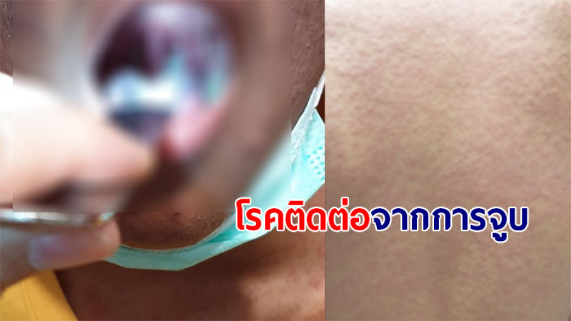 อุทาหรณ์! หนุ่ม 15 ป่วยมีไข้ ปวดหัว เบื่ออาหาร ผื่นขึ้น รู้ทีหลังเป็นโรคติดต่อจากการจูบ 