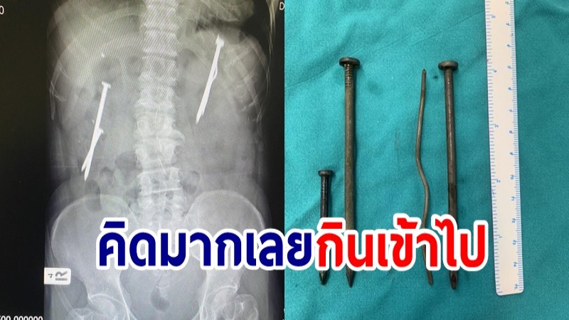 ผงะ! หมอ รพ.ดำเนินสะดวกเจอตะปู 4 นิ้ว ในท้องคนไข้