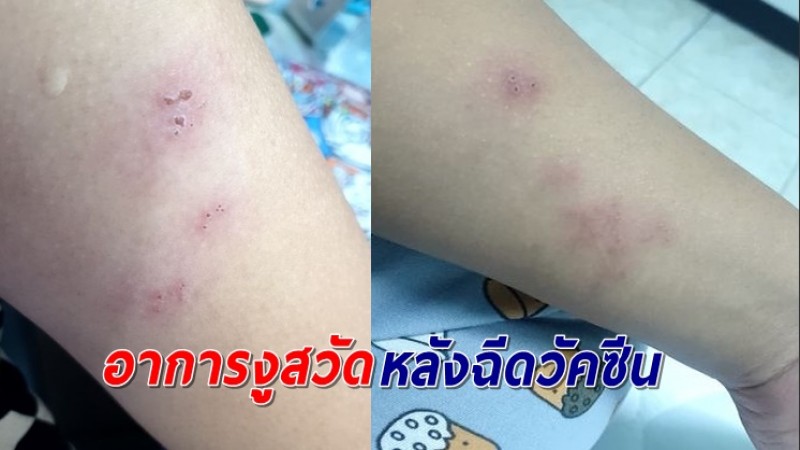 "จ่าพิชิต" เผยอาการงูสวัด หลังฉีดวัคซีนโควิด-19 รักษาไม่ยาก