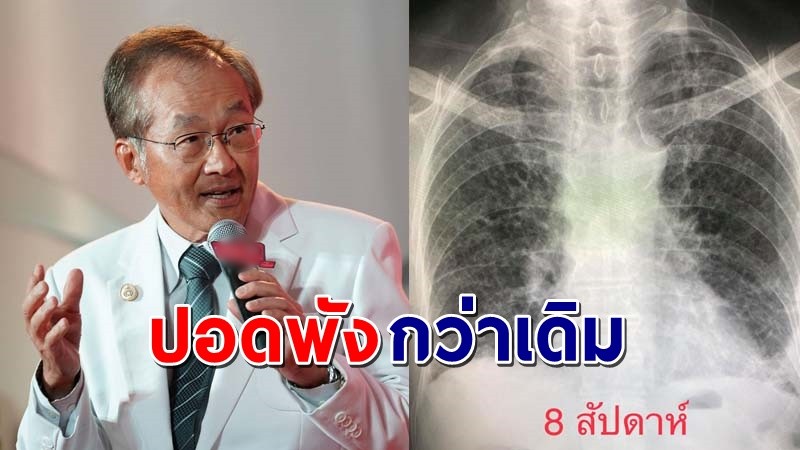 "หมอมนูญ" โพสต์ภาพเอ็กซเรย์ปอดผู้ป่วยใหม่ ชี้ไวรัสรอบนี้เล่นงาน "ปอด" รุนแรงกว่าเดิม !