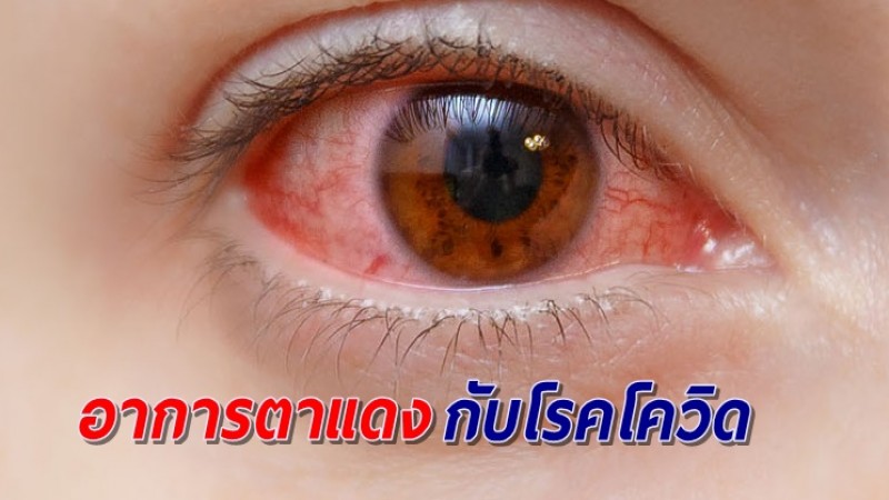 แพทย์แนะวิธีสังเกตอาการตาแดง ที่จะสงสัยว่าเกิดจากการติดเชื้อโควิด-19 มักมีอาการอื่นร่วมด้วย