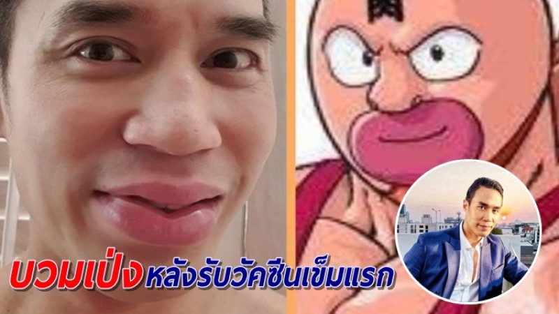 "ดอม เหตระกูล" แพ้วัคซีน ฉีดเข็มแรกถึงกับแปลงร่าง!