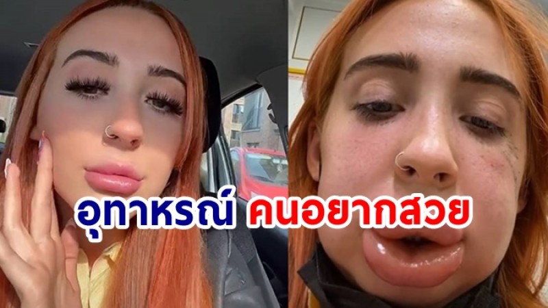 อุทาหรณ์! สาวไปฉีดสลายฟิลเลอร์ปาก เกิดแพ้หนัก! บวมเป็น 2 เท่า 