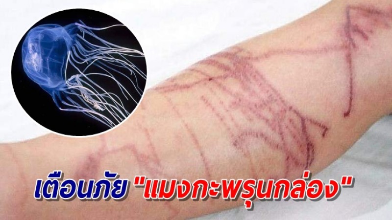 กรมอุทยานฯเตือนภัย "แมงกะพรุนกล่อง" แนะวิธีปฐมพยาบาล หลังพบเด็ก 9 ขวบ เสียชีวิต ที่หาดริ้น