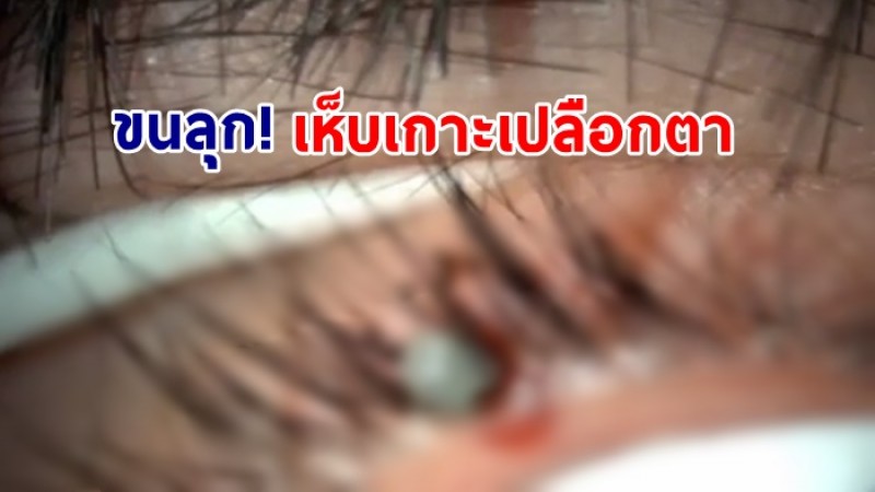 หมอเผยคลิป ดึงเห็บออกจากเปลือกตา อุทาหรณ์ของคนชอบเล่นกับสุนัข