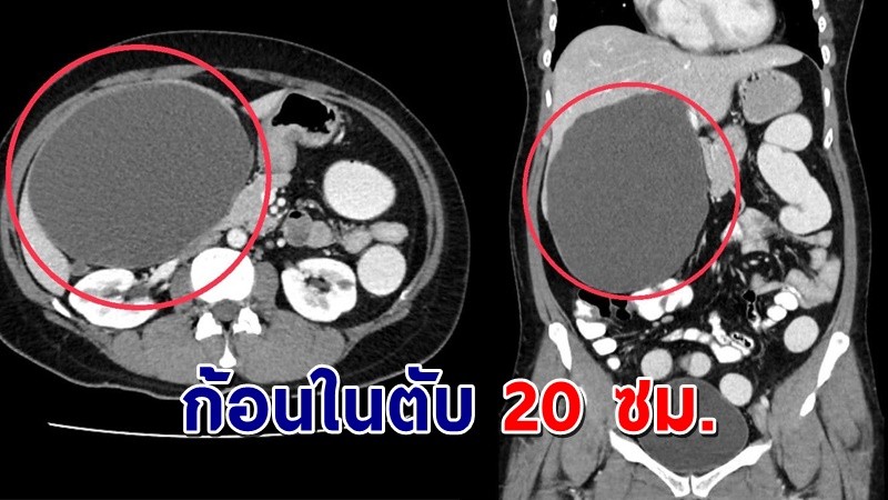 คนไข้อายุ 44 ปี ท้องอืด แน่นท้อง นานกว่า 1 ปี พบก้อนในตับขนาดใหญ่ !