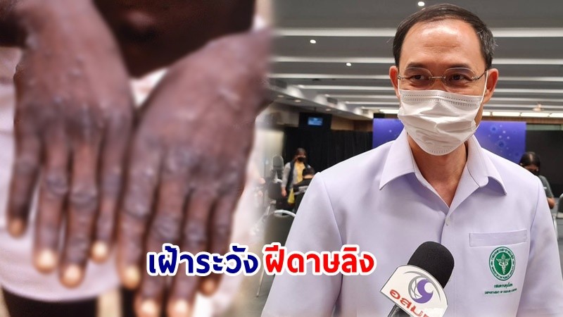 สั่งเฝ้าติดตาม ! ผู้สัมผัสใกล้ชิด "ผู้ป่วยฝีดาษลิง" 12 ราย ยันยังไม่พบในไทย