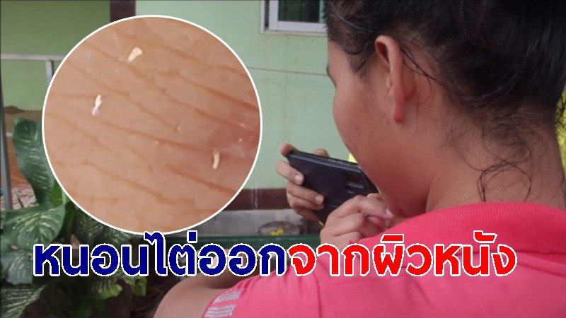 สาวอุดรฯ เจอตัวประหลาดคล้ายหนอนไต่ออกจากผิวหนัง คนในบ้านติดแล้วรวม 4 ราย