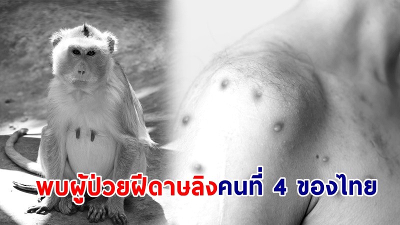ด่วน ! พบผู้ป่วย "ฝีดาษลิง" คนที่ 4 ของไทย เป็นหญิงมีประวัติใกล้ชิดกับชายชาวต่างชาติ