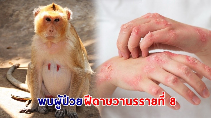 พบผู้ป่วย "ฝีดาษวานรรายที่ 8" เป็นชาวไทย กลับจากกาตาร์