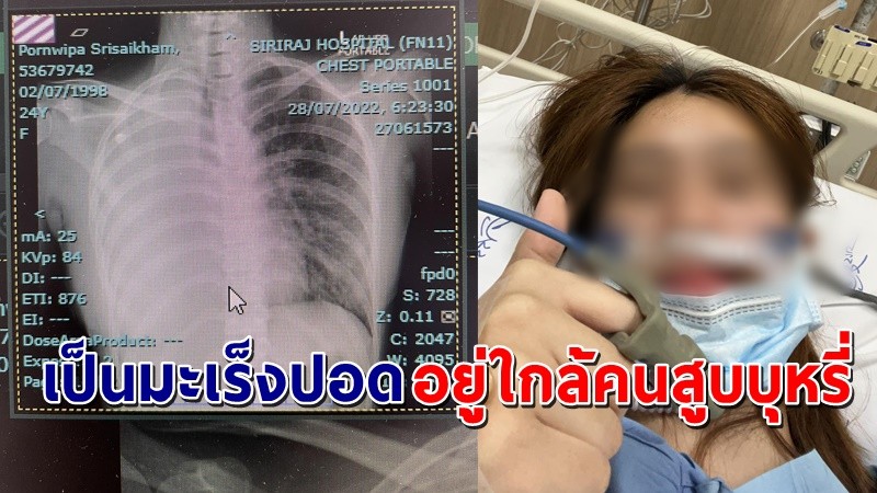 "พยาบาลวัย 24 ปี" โพสต์ พบเป็นมะเร็งปอดระยะสุดท้าย ทั้งๆที่ไม่เคยสูบบุหรี่ !