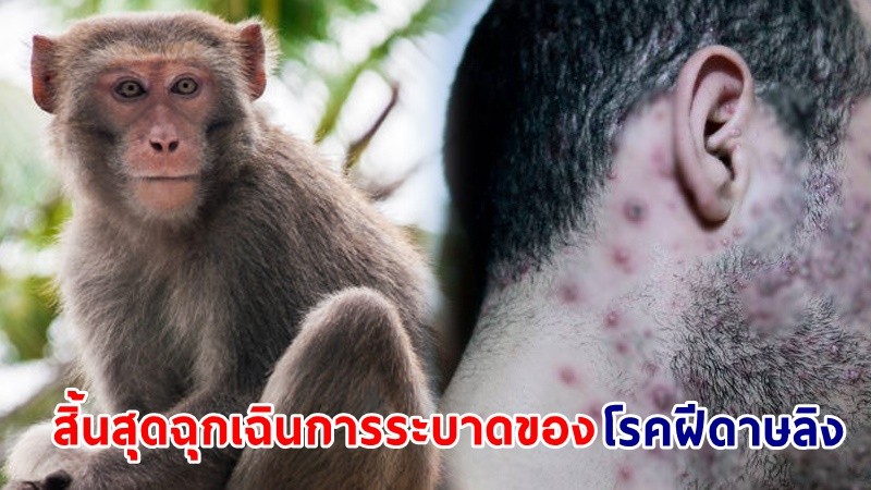 "WHO" ประกาศ! สิ้นสุดฉุกเฉินการระบาดของ "โรคฝีดาษลิง"