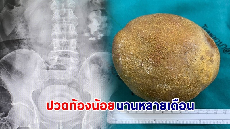 "ตาวัย 74 ปี" ปวดท้องน้อยมาหลายเดือน ก่อนไปหาหมอ ตรวจพบ "นิ่วขนาดยักษ์" !