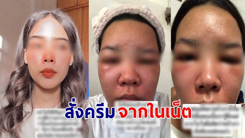 บทเรียนไม่มีวันลืม ! "สาว" เตือน ซื้อครีมขาวจากในเน็ต  หน้าอักเสบบวมแดง !