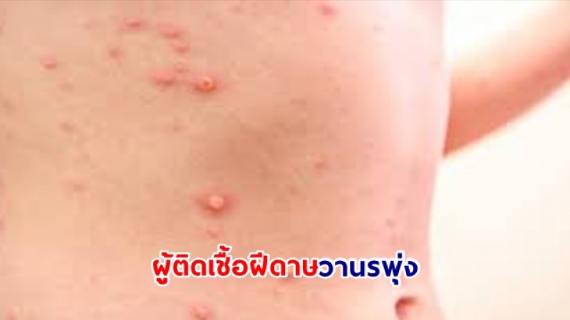 พบ! ผู้ติดเชื้อฝีดาษวานรพุ่ง ย้ำงดมีเพศสัมพันธ์ที่ไม่ปลอดภัย