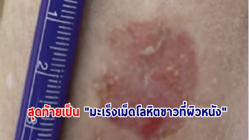 หญิงไต้หวัน อายุ 65 ปี มีรอยแดงเป็นสะเก็ดตามร่างกาย ไม่เจ็บ-ไม่คัน สุดท้าย เป็น "มะเร็งเม็ดโลหิตขาวที่ผิวหนัง"