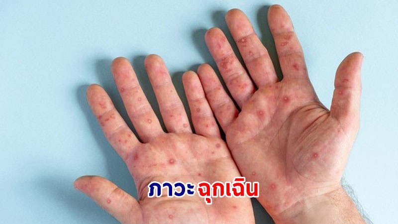 WHO ประกาศ! "ฝีดาษลิง" เป็นภาวะฉุกเฉินด้านสาธารณสุขระดับโลก