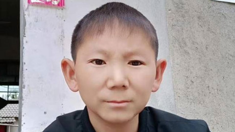  หนุ่มจีน  อายุ 34 ปี  แต่ใบหน้ายังเด็ก จากผลกระทบ  ต่อมใต้สมองกระเทือน 